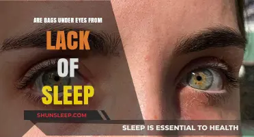 Sleep Deprivation: The Cause of Under-Eye Bags