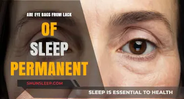 Lack of Sleep: Do Eye Bags Vanish?