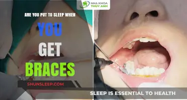 Do Braces Require Anesthesia? Debunking the Sleep Myth