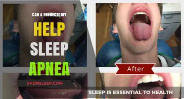 Frenectomy for Sleep Apnea: A Potential Solution for Better Sleep?