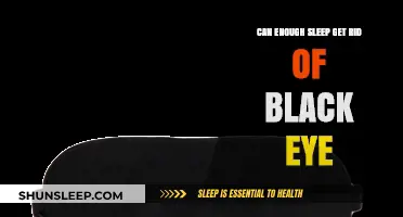 Sleep and Black Eyes: Can Rest Alone Heal Dark Circles?