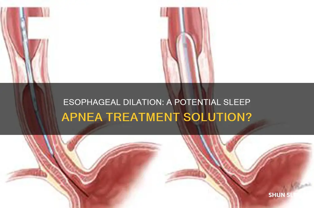 can esophageal dilation help sleep apnea