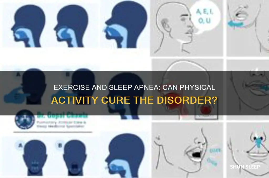 can exercise get rid of sleep apnea
