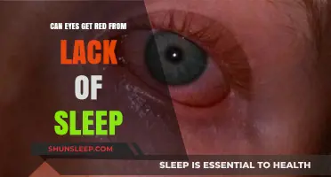 Lack of Sleep and Red Eyes: Causes, Effects, and Remedies