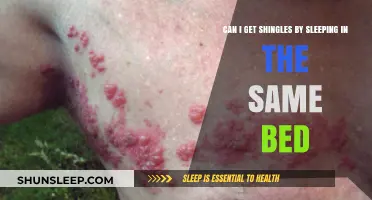 Sleeping Together: Can Sharing a Bed Spread Shingles?