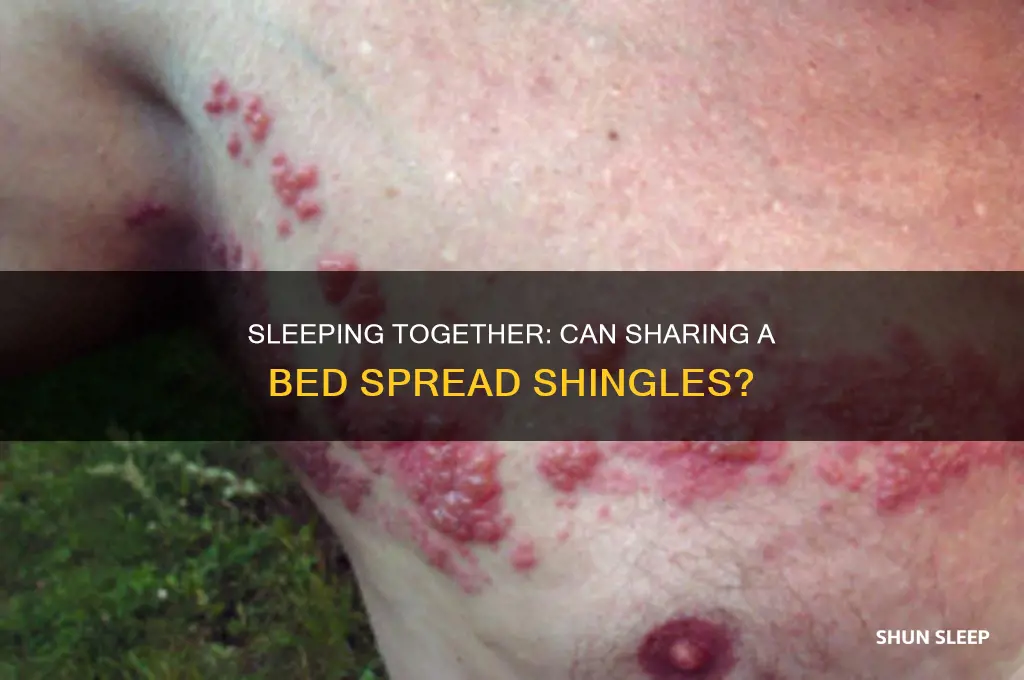 can i get shingles by sleeping in the same bed