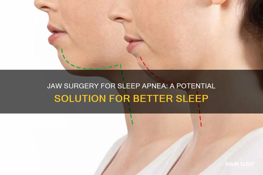 can jaw surgery help sleep apnea