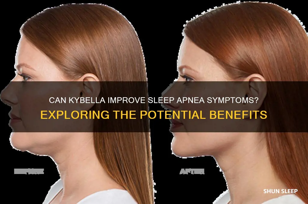 can kybella help sleep apnea