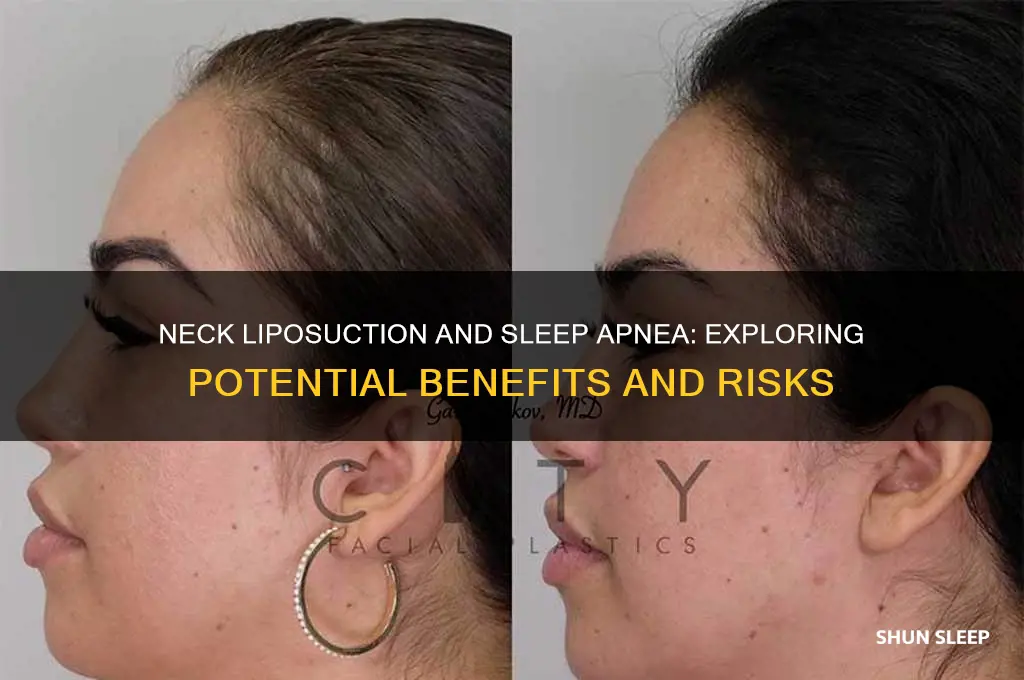 can neck liposuction help sleep apnea