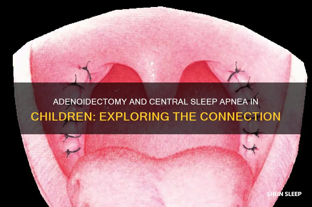 can removal of adenoids help central sleep apnea in children