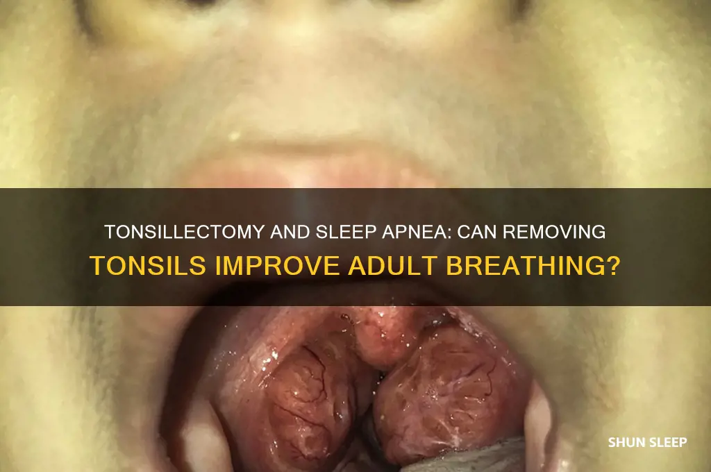 can removing tonsils help with sleep apnea in adults