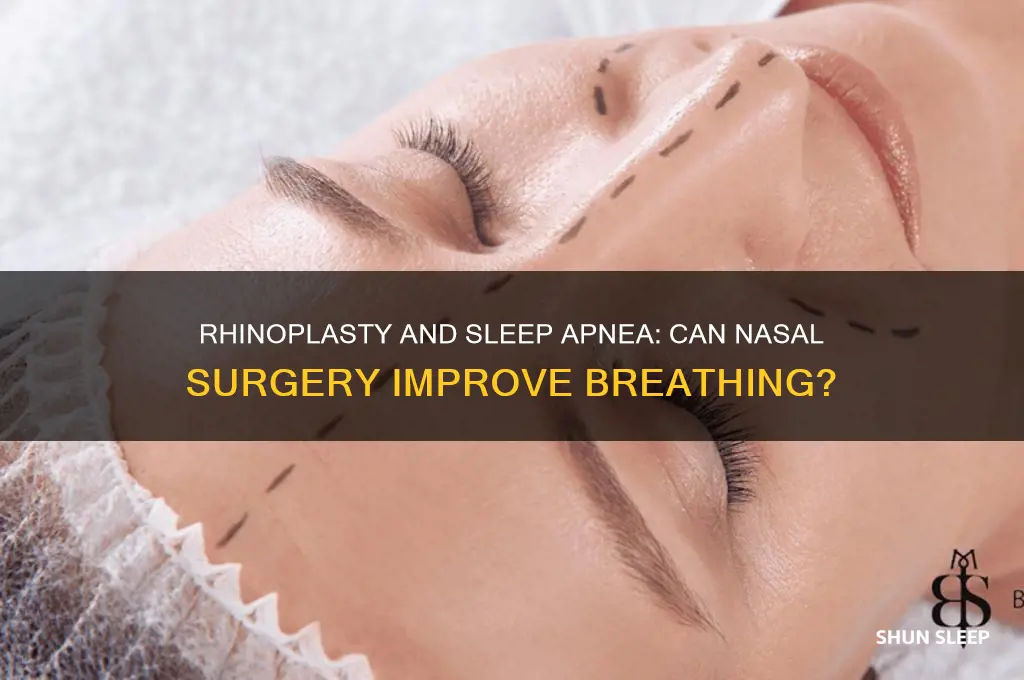can rhinoplasty help sleep apnea