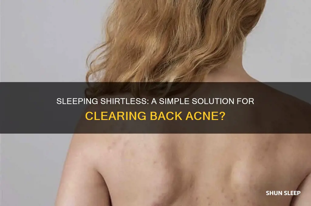can sleeping without a shirt help back acne