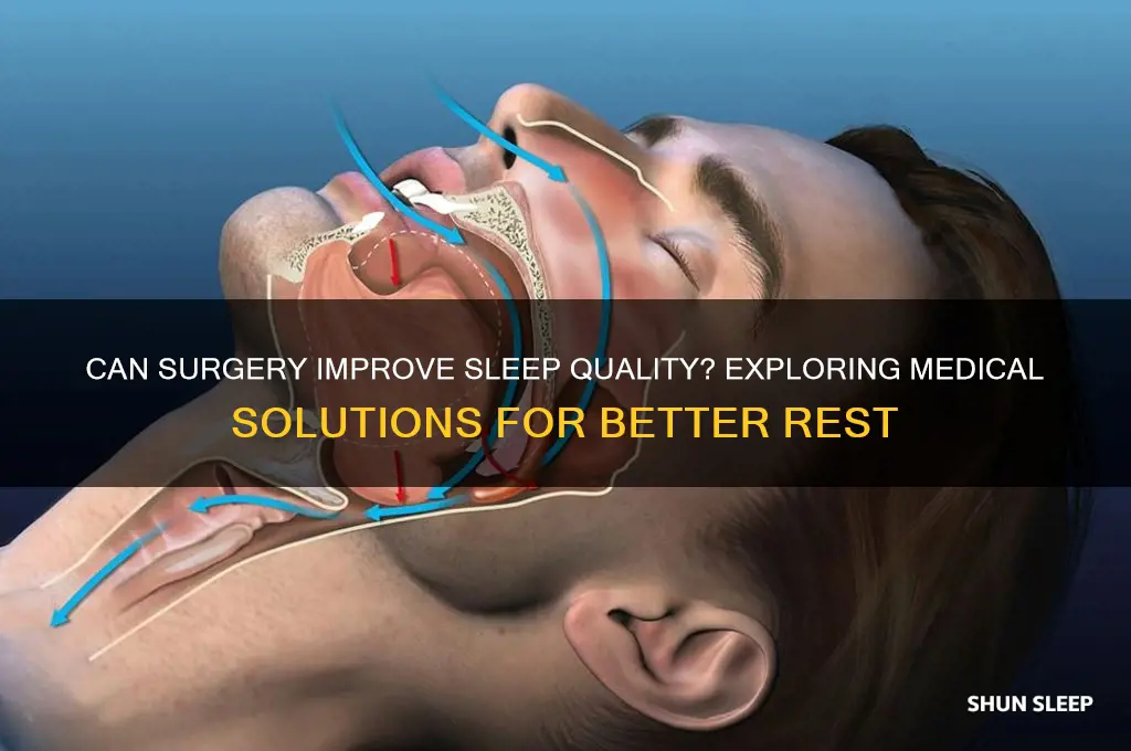 can surger help with sleep