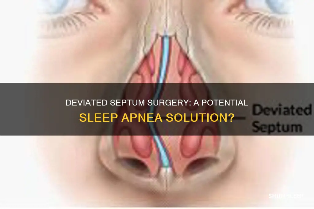 can surgery for deviated septum help sleep apnea