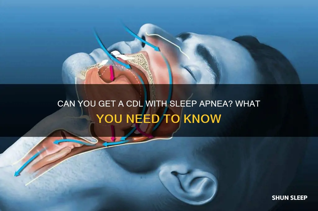 can you get a cdl with sleep apnea