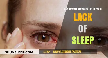 Lack of Sleep and Bloodshot Eyes: Understanding the Connection