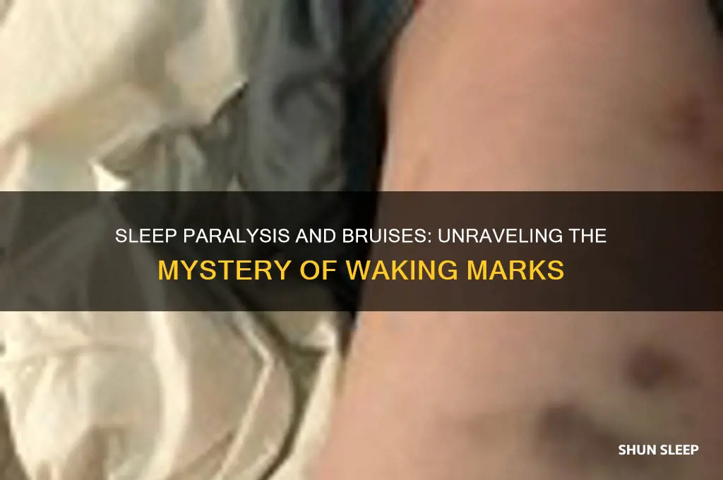 can you get bruises from sleep paralysis