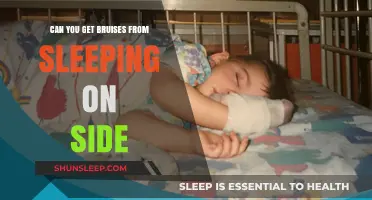 Sleeping on Your Side: Understanding Bruises and How to Prevent Them