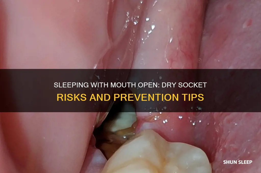 can you get dry socket from sleeping with mouth open