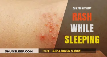Can You Get Heat Rash While Sleeping? Causes and Prevention Tips