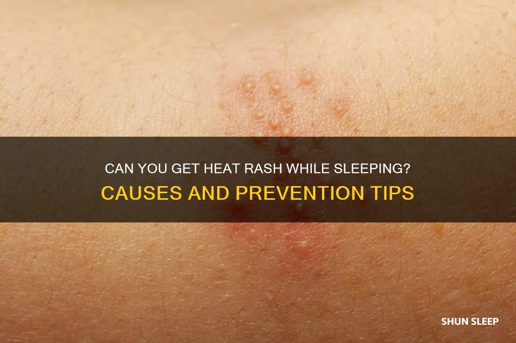 can you get heat rash while sleeping
