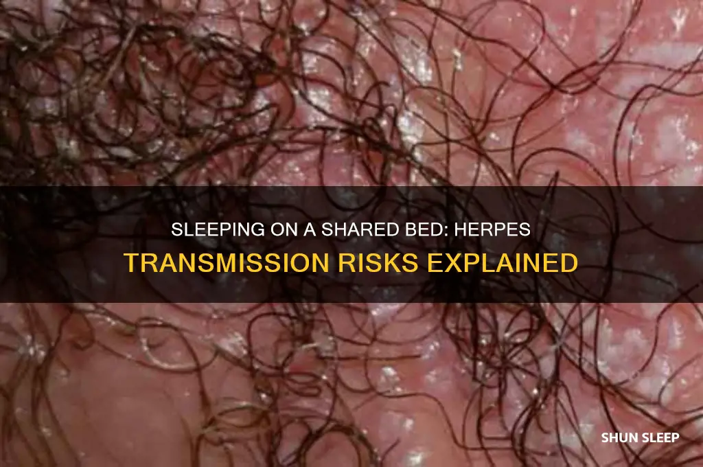 can you get herpes by sleeping on bed