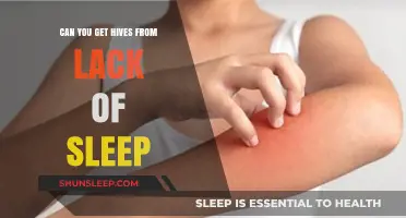 Lack of Sleep and Hives: Understanding the Surprising Connection