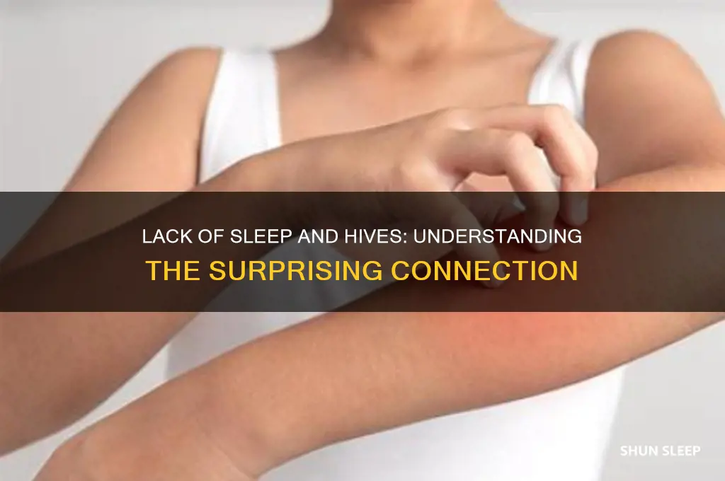 can you get hives from lack of sleep