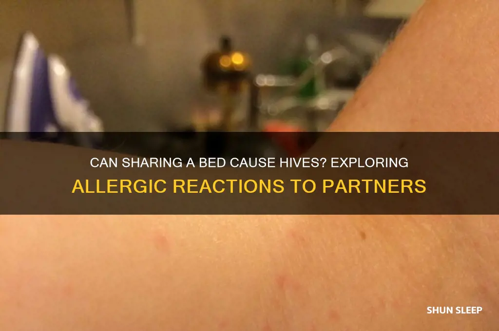 can you get hives from sleeping with someone else