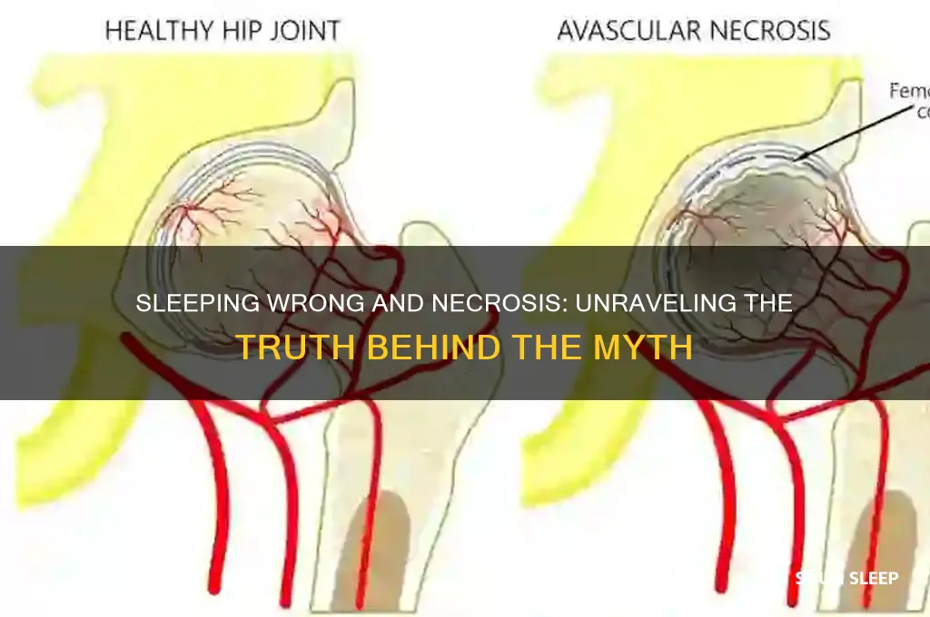 can you get necrosis from sleeping wrong