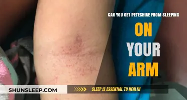 Sleeping on Your Arm: Can It Cause Petechiae? Unveiling the Truth