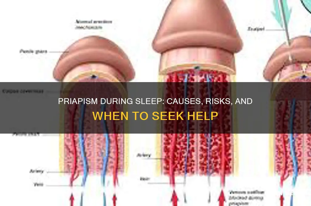 can you get priapism in your sleep