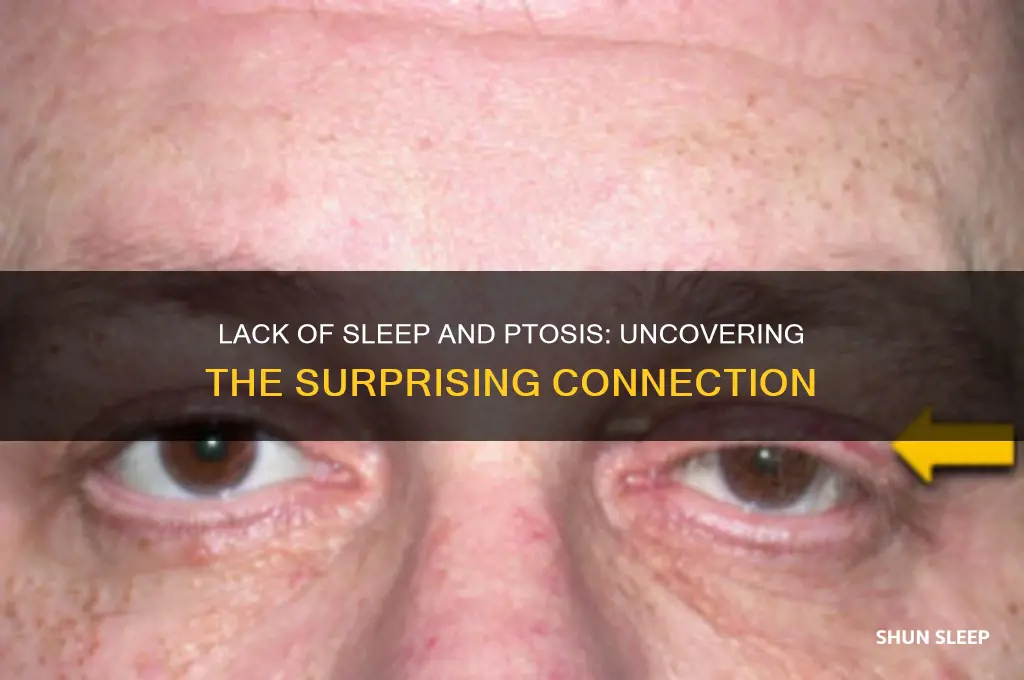 can you get ptosis from lack of sleep