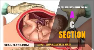 C-Section Anesthesia: Understanding Sedation During Cesarean Delivery