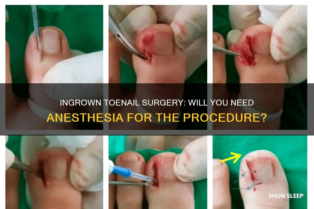 can you get put to sleep for ingrown toenail surgery