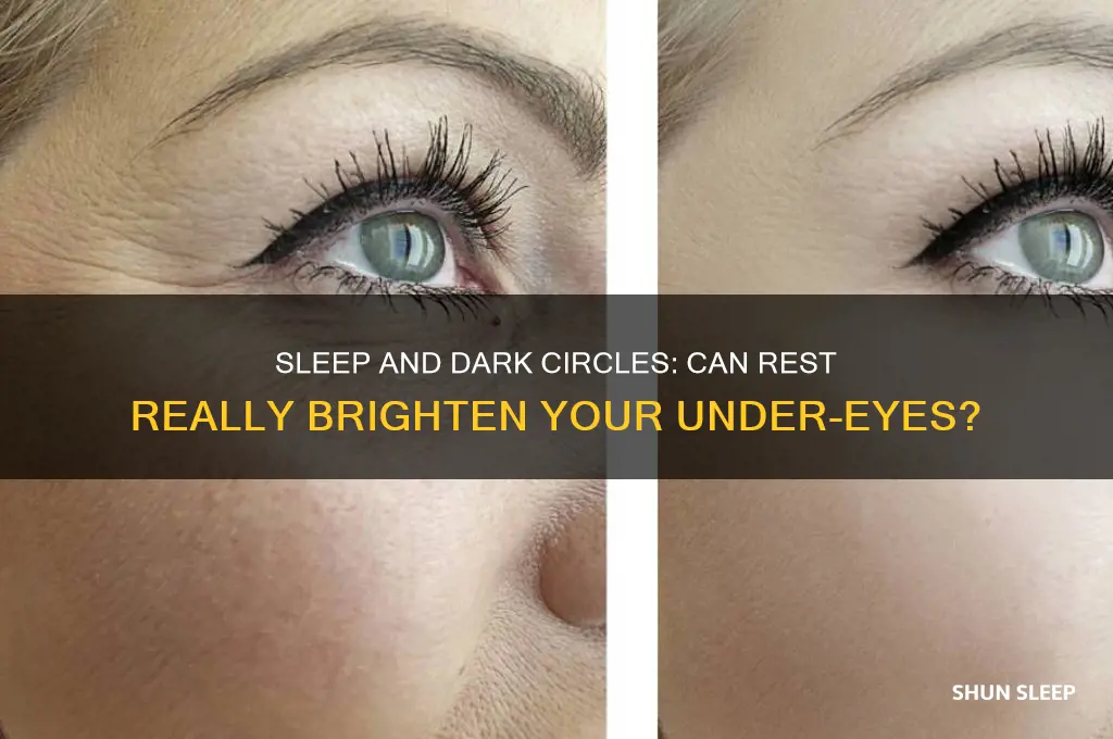 can you get rid of dark circles by sleeping