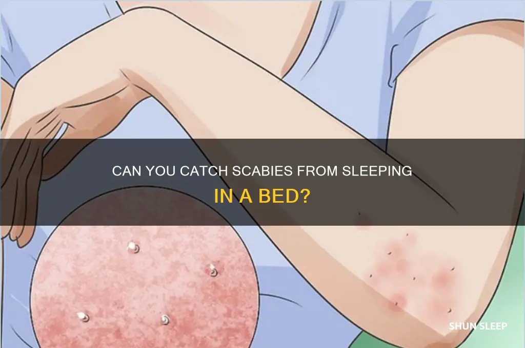 can you get scabies from sleeping in a bed
