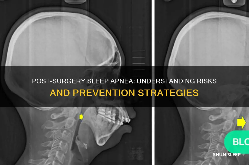 can you get sleep apnea after surgery