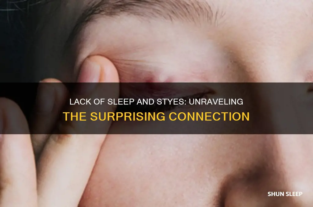 can you get styes from lack of sleep
