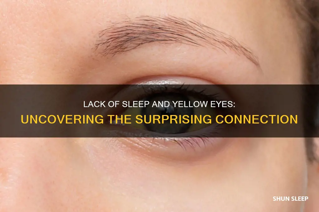 can you get yellow eyes from lack of sleep