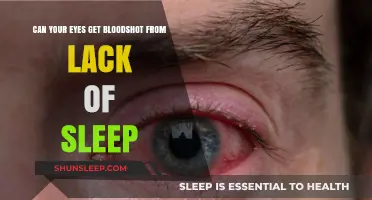Lack of Sleep and Bloodshot Eyes: Understanding the Connection