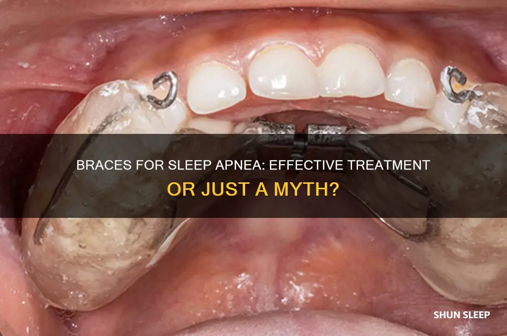 do braces help sleep apnea