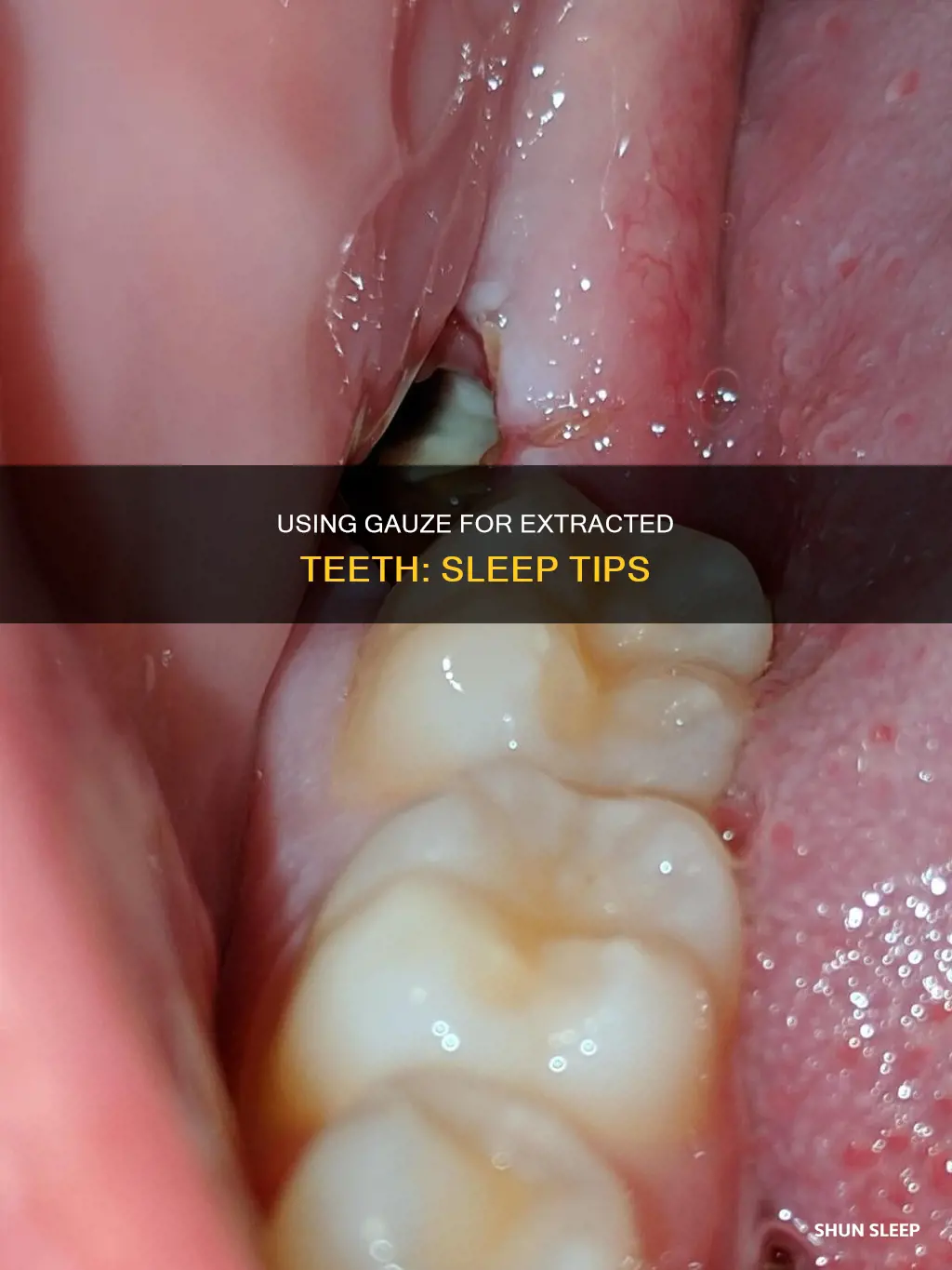 do i use a gauze on extracted tooth while sleeping