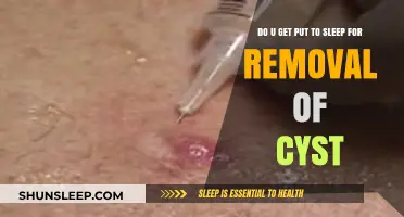 Cyst Removal Procedure: Understanding Anesthesia and What to Expect