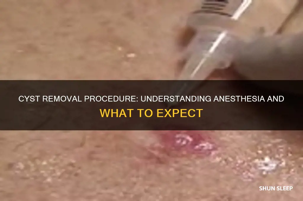 do u get put to sleep for removal of cyst