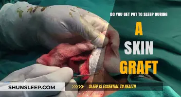 Skin Graft Anesthesia: Understanding Sedation During Your Procedure