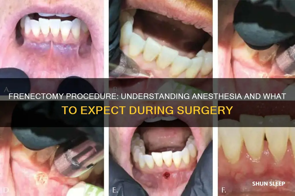 do you get put to sleep for a frenectomy