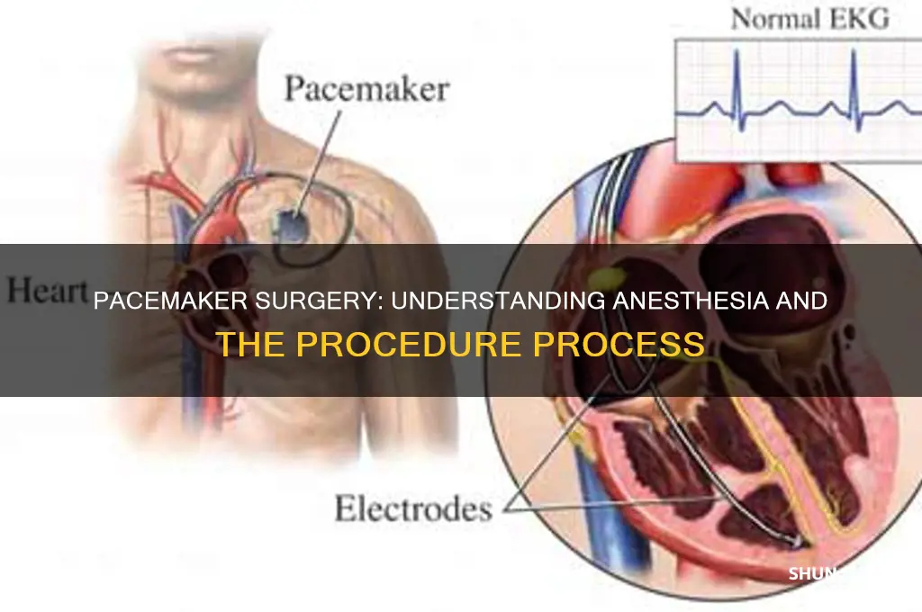 do you get put to sleep for a pacemaker