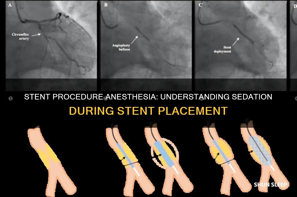do you get put to sleep for a stent